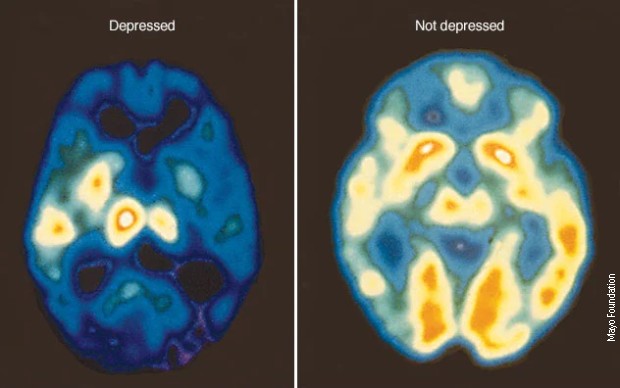 ПЕТ снимак мозга оболелог од депресије и здравог